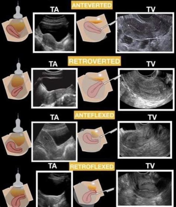 What is the meaning of uterine Synechiae