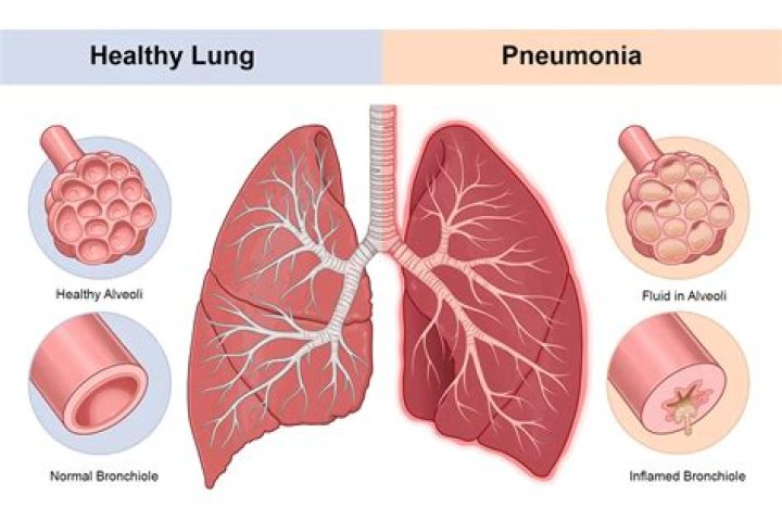 What is the most common form of pneumonia