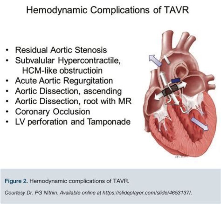 What is the most serious complication of rifampin