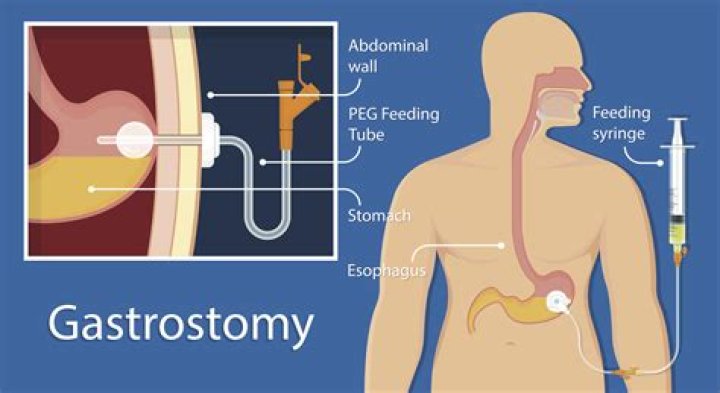What is the purpose of a gastrostomy tube