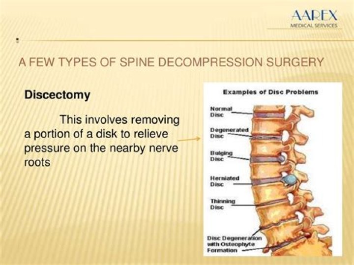 What is the recovery time for spinal decompression surgery
