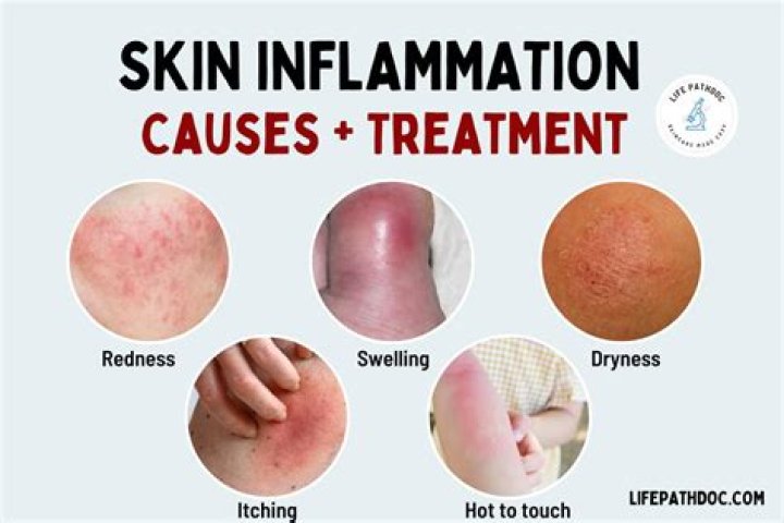 What is the skin condition characterized by redness caused by inflammation