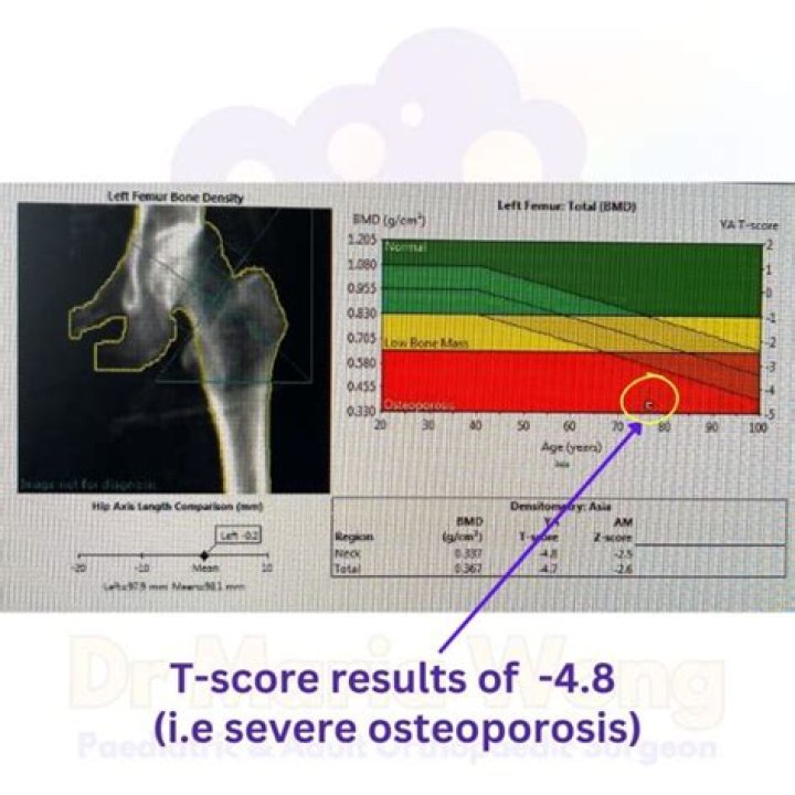 What is the T score for severe osteoporosis