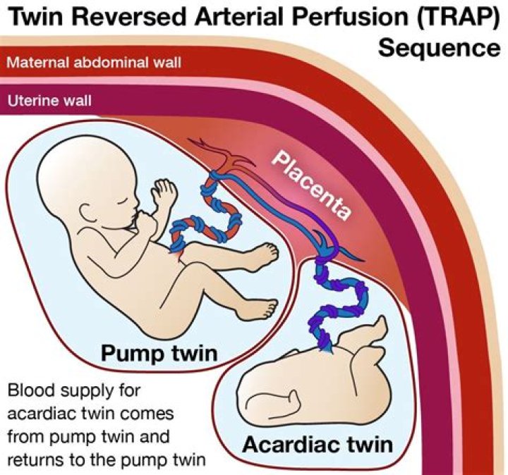 What is twin to twin transfusion survival rate