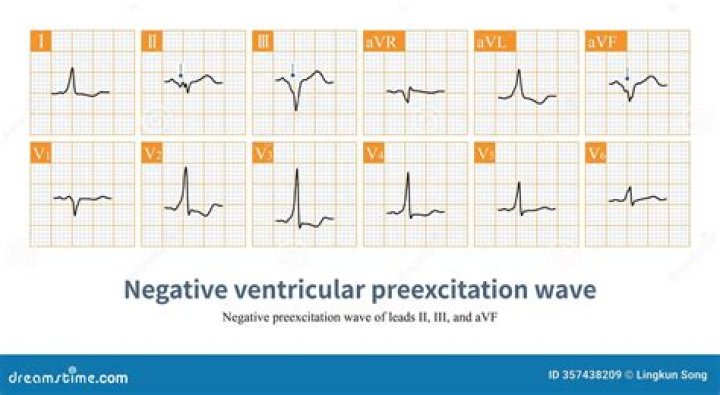 What is ventricular Preexcitation