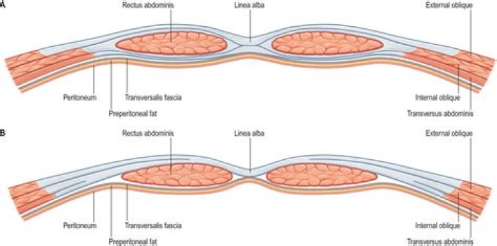 What is within the rectus sheath