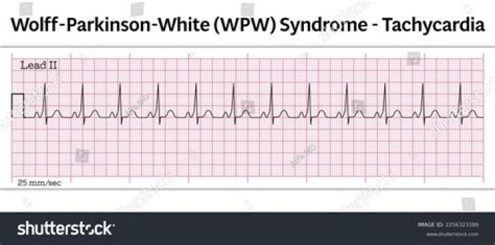 What is Wolff Parkinson White pattern