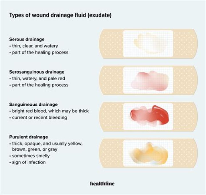 What is wound drainage