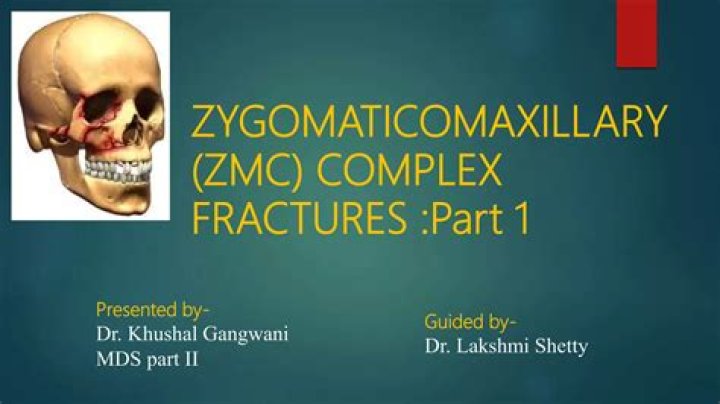 What is Zygomaticomaxillary complex fracture