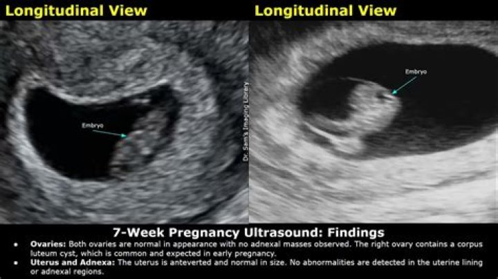 What size should the CRL be at 7 weeks