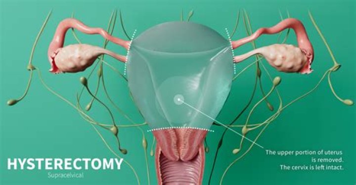 What test are done before a hysterectomy