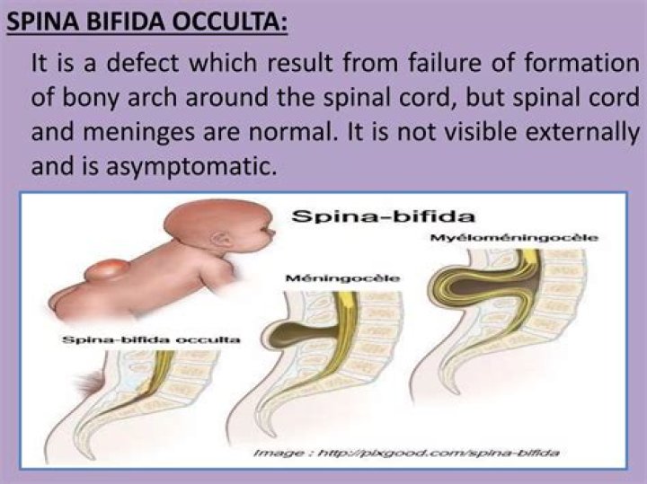 What type of spina bifida is the most severe