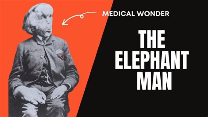 What was Joseph Merrick famous for