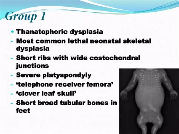 When was Thanatophoric dysplasia discovered