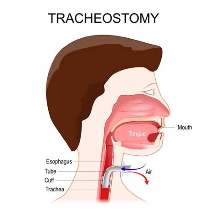 Where are tracheostomy tubes placed