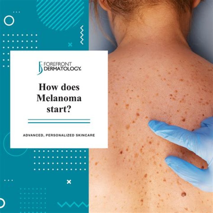 Where does melanoma spread to first