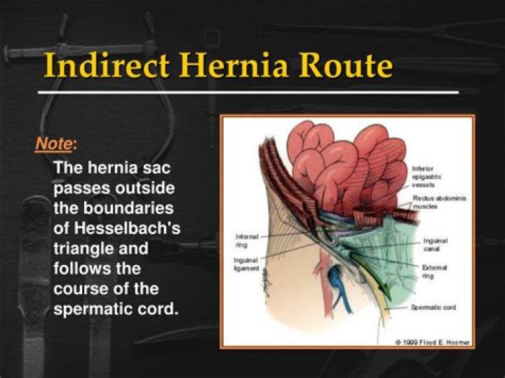 Where is an indirect inguinal hernia located