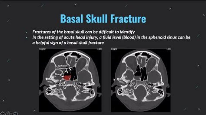 Where is the basal skull