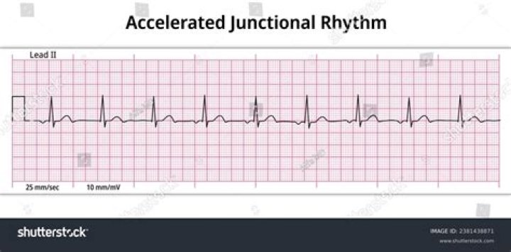Where is the P wave in a junctional rhythm