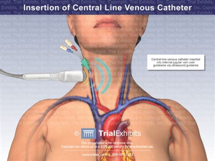 Where should the tip of a central venous line be