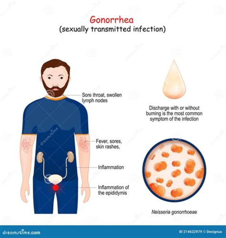 Which is worse chlamydia or gonorrhea