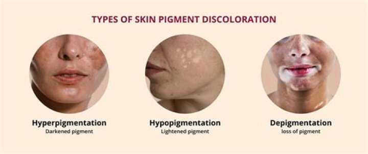 Which of the following is considered a pigmentation abnormality