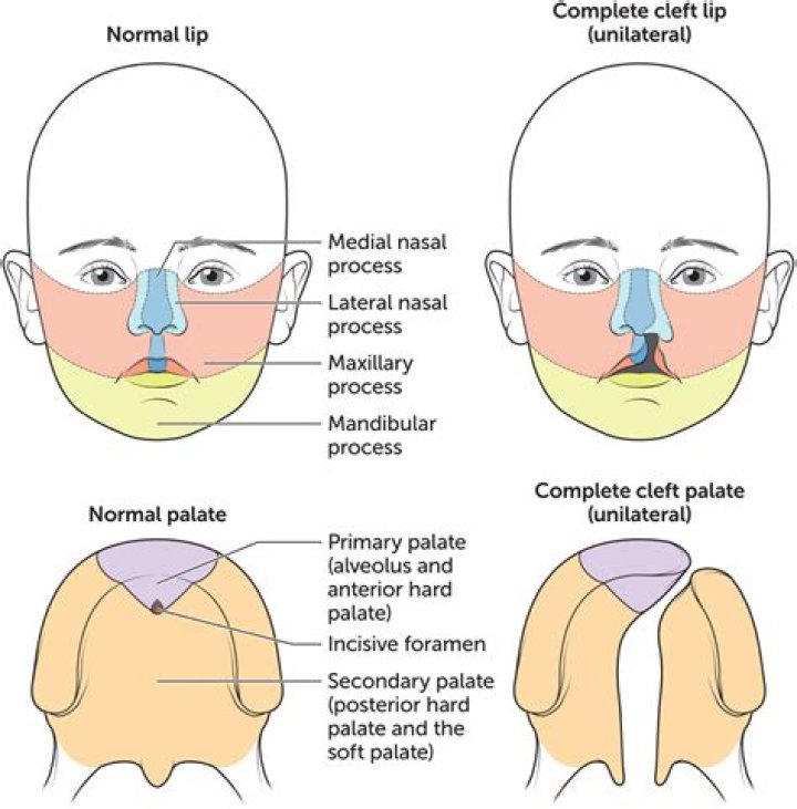 Who discovered cleft lip