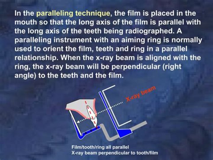 Why a film or sensor holder is necessary with the paralleling technique