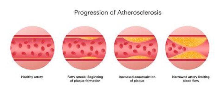 Why are arteries more likely to develop atherosclerosis