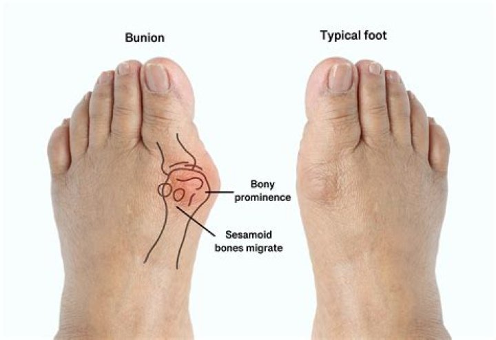 Why are bony prominences susceptible to skin damage