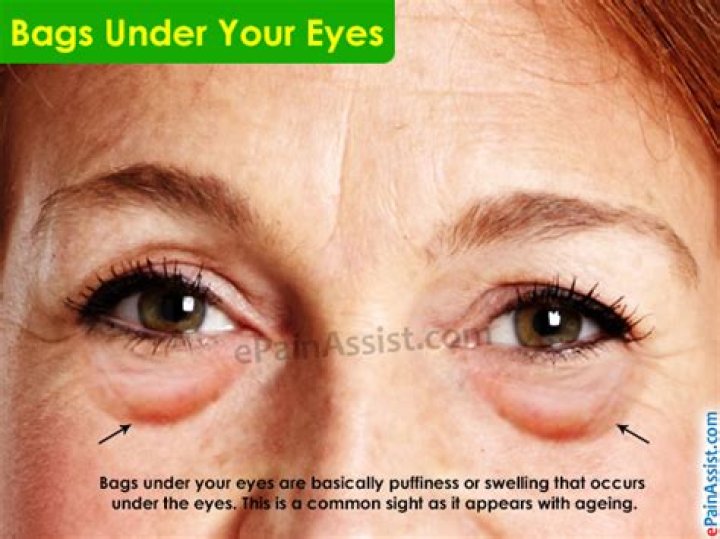 Why do I have big bags under my eyes