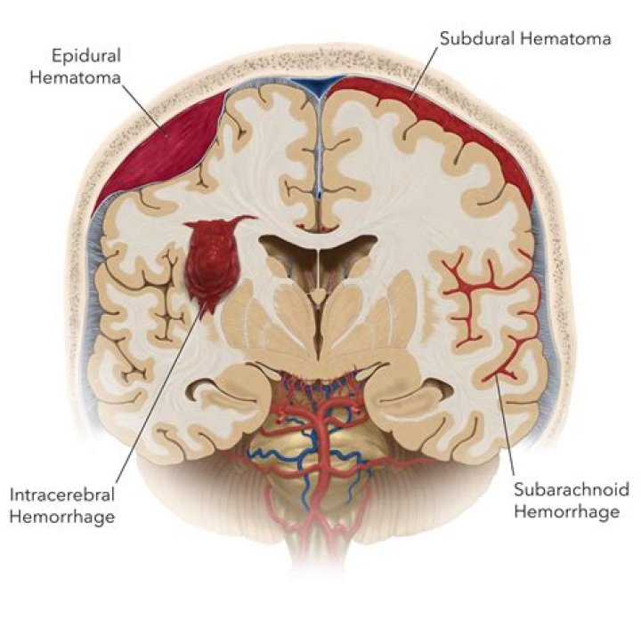 Why is subdural hemorrhage so dangerous
