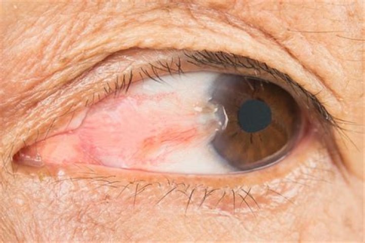 Why pterygium occurs on nasal side