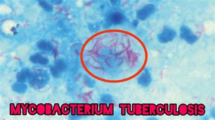 Why there is beaded appearance of Mycobacterium tuberculosis