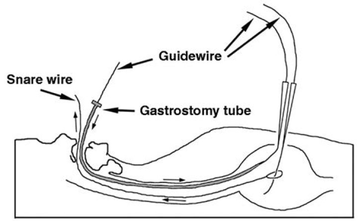 Why would someone need a gastrostomy